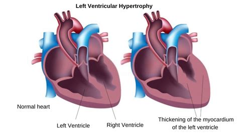 lv shows mild concentric hypertrophy|does lvh cause chest pain.